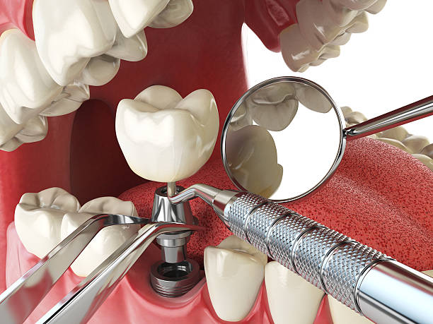 Best Emergency Root Canal Treatment in Yale, OK